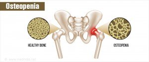 osteopenia-decreased-bone-density